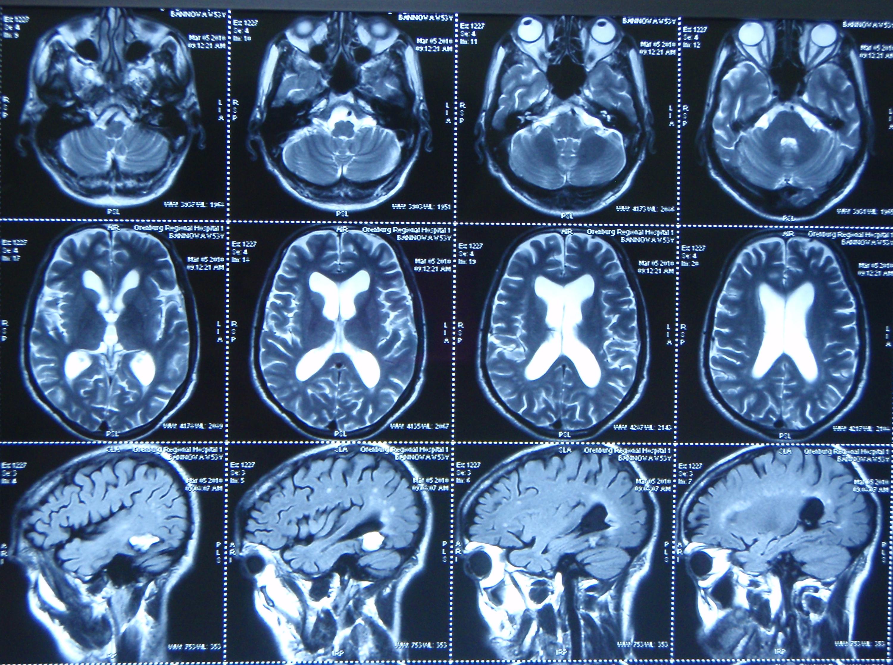 Что лучше кт головного мозга или мрт. Мрт магнитно-резонансная томография головного мозга. Компьютерная томография кт головного мозга. Кт томограмма головного мозга. Мрт мозга сбоку.